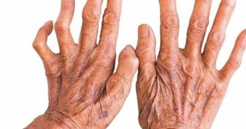 विश्वभर ७२ औँ विश्व कुष्ठरोग दिवस मनाइँदै