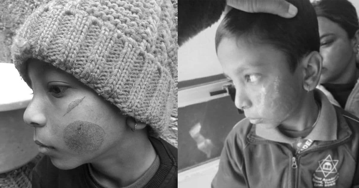 विद्यार्थीलाई तातो पन्यूले डाम्ने शिक्षिका पक्राउ